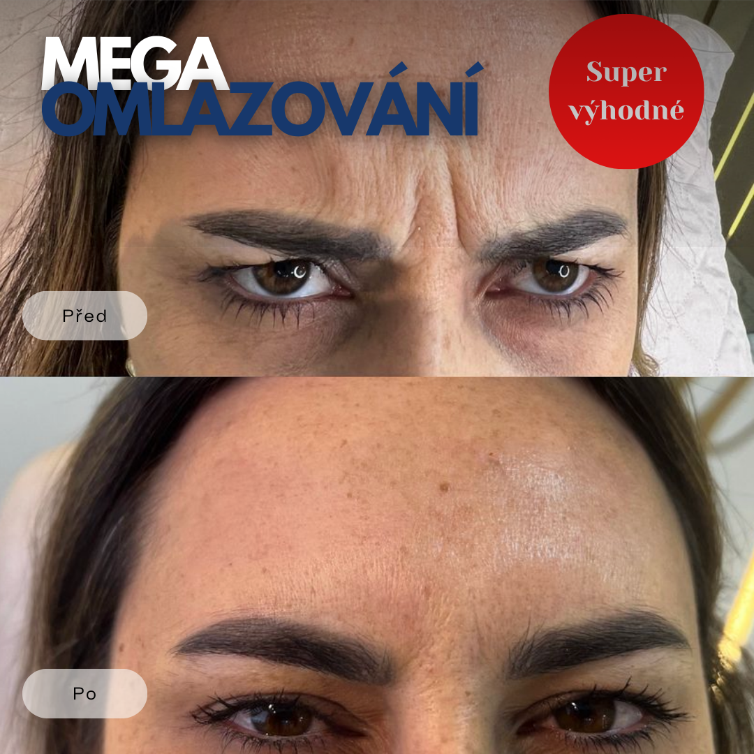 Mega omlazování v Plzni v Medical institut. Botox, niťový lifting, zvětšení rtů za super ceny