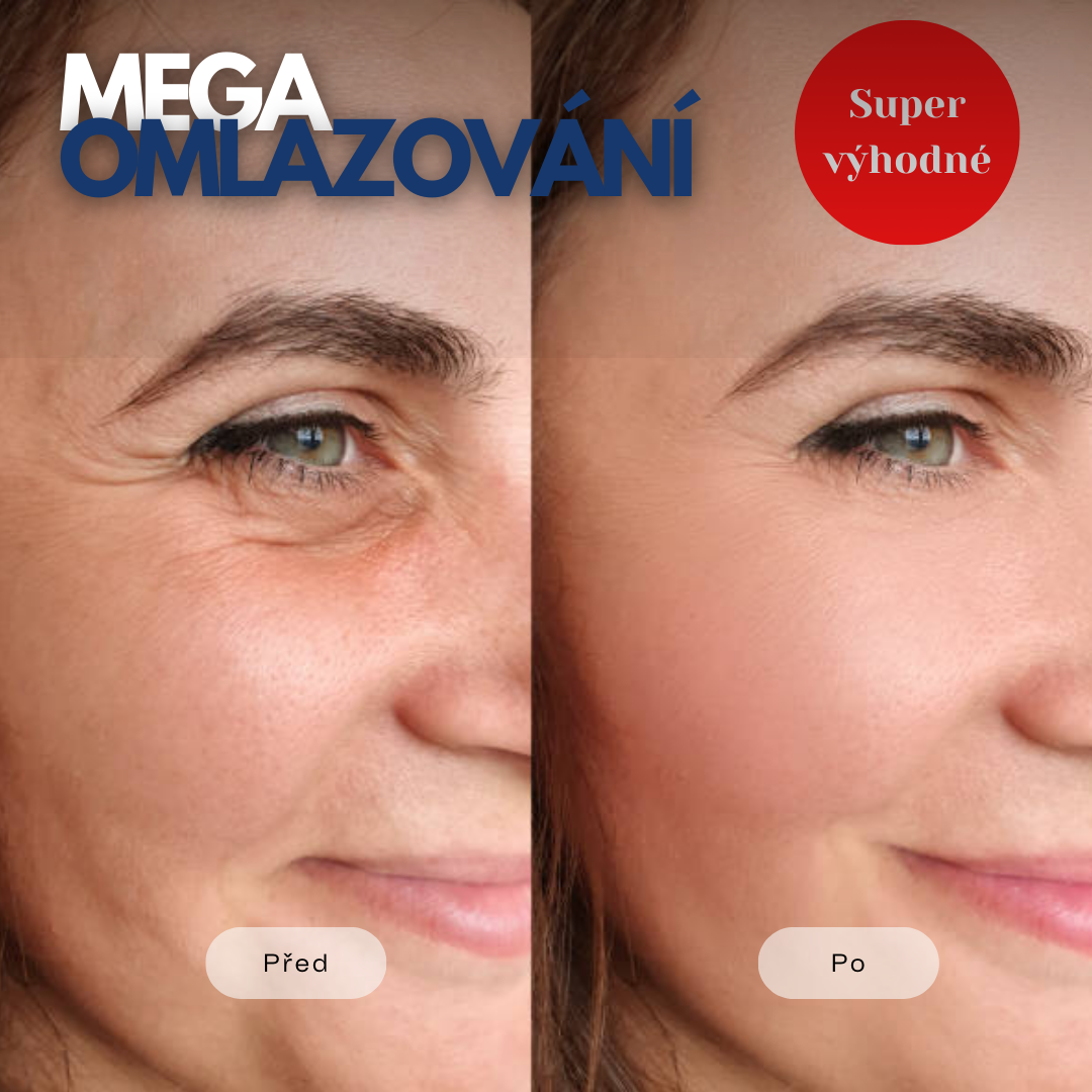 Mega omlazování v Plzni v Medical institut. Botox, niťový lifting, zvětšení rtů za super ceny