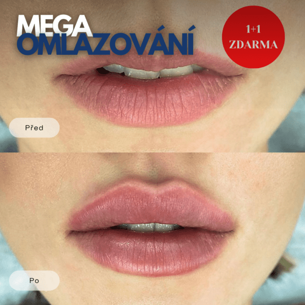 Mega omlazování v Plzni v Medical institut. Botox, niťový lifting, zvětšení rtů za super ceny